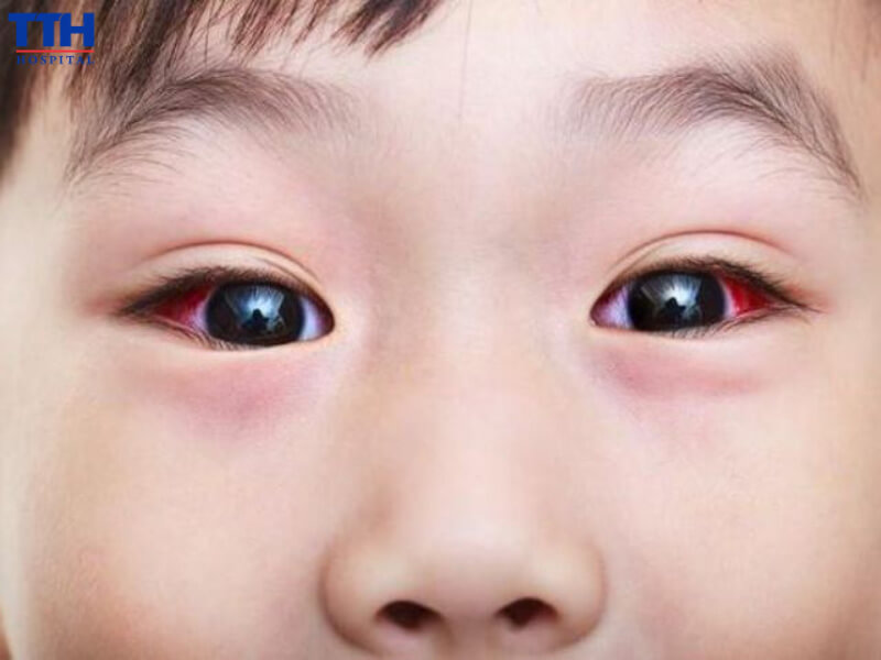 Viêm kết mạc (đau mắt đỏ)