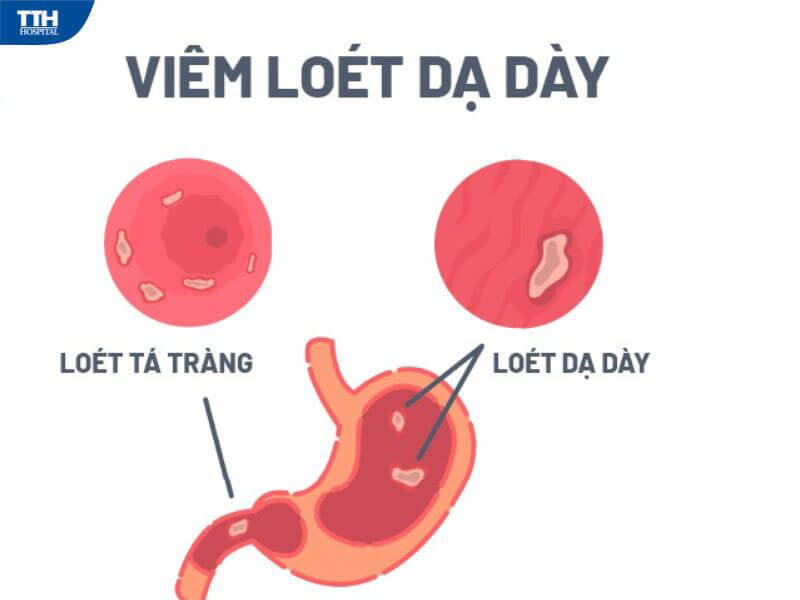Viêm loét dạ dày, tá tràng