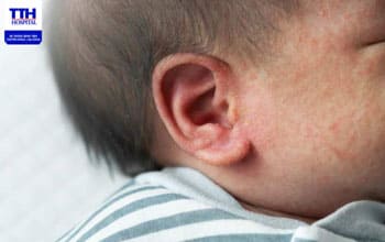 5 NGUYÊN NHÂN PHỔ BIẾN GÂY RÔM SẢY Ở TRẺ NHỎ