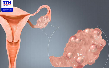 5 THÓI QUEN GIÚP KIỂM SOÁT HỘI CHỨNG BUỒNG TRỨNG ĐA NANG