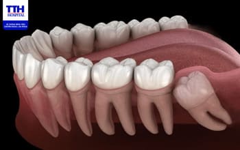 DẤU HIỆU MỌC RĂNG KHÔN VÀ CÁCH GIẢM ĐAU HIỆU QUẢ