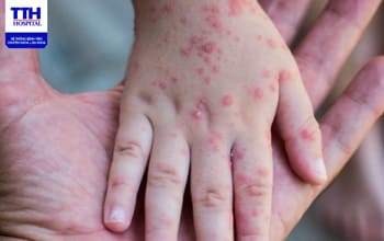 NGUY CƠ TIỀM ẨN VÀ GIẢI PHÁP BẢO VỆ SỨC KHỎE KHI TRẺ EM MẮC BỆNH SỞI