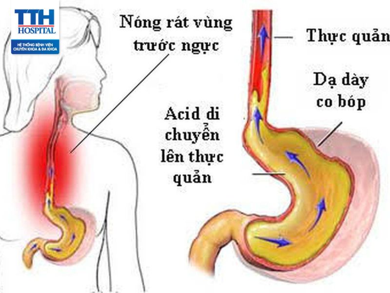 Co thắt thực quản: Triệu chứng, nguyên nhân và cách chữa trị