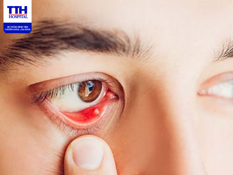 Bệnh đau mắt hột là gì? Nguyên nhân, triệu chứng mắc phải và cách điều trị hiệu quả