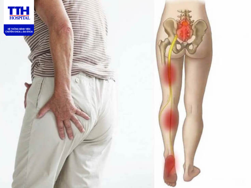 Đau thần kinh tọa là gì? Cách điều trị đau thần kinh tọa