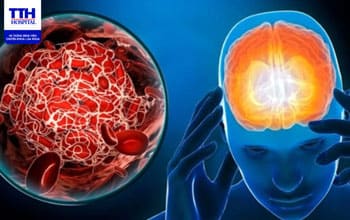 ĐỘT QUỴ LÀ GÌ? NGUYÊN NHÂN, DẤU HIỆU NHẬN BIẾT VÀ CÁCH XỬ LÝ KỊP THỜI