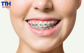 ĐỪNG BỎ LỠ CÁC BUỔI TÁI KHÁM KHI NIỀNG RĂNG