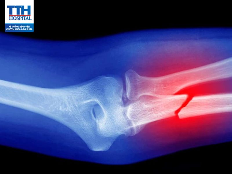Gãy xương: Nguyên nhân, biểu hiện và phương pháp điều trị