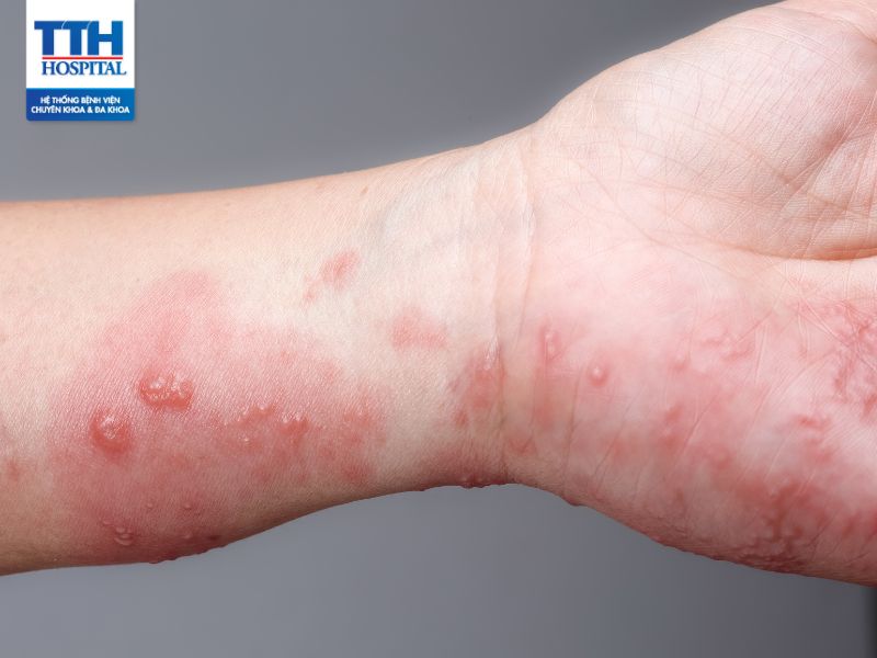 Bệnh giời leo(zona): Triệu chứng và cách điều trị 