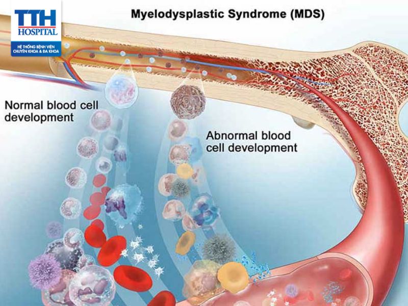 Hội chứng rối loạn sinh tủy (MDS): Nguyên nhân và triệu chứng