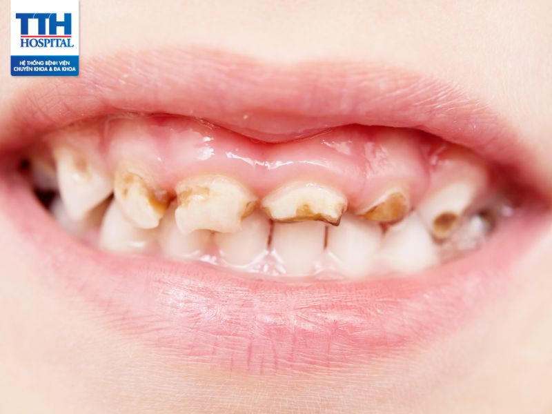Men răng là gì? Dấu hiệu nhận biết bị hỏng men răng