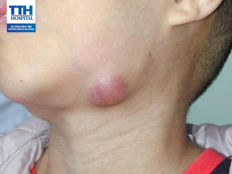 Lao hạch: Triệu chứng, nguyên nhân, điều trị và các biến chứng nguy hiểm