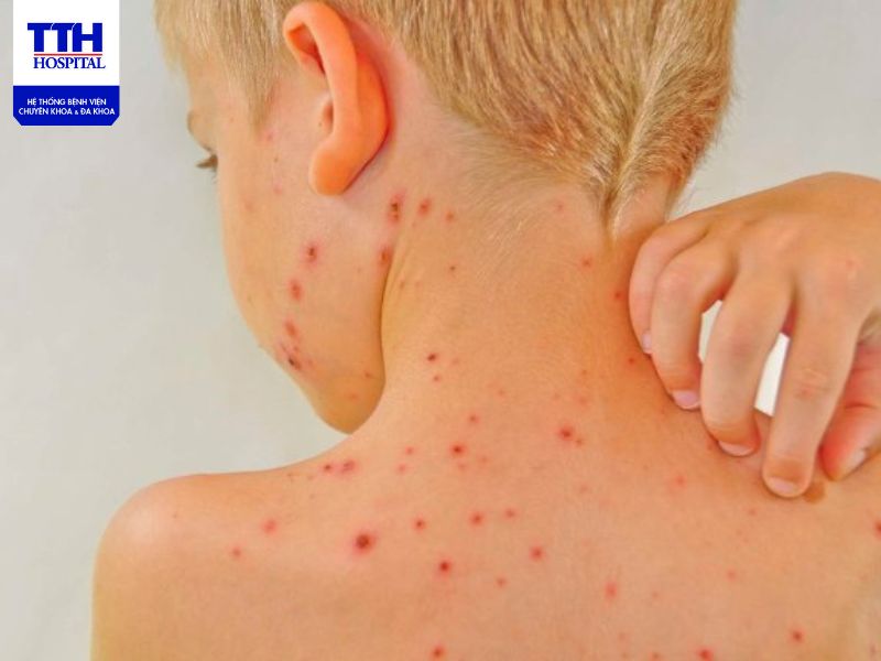 Hiểu Biết Về Lupus Ban Đỏ Hệ Thống và Cách Điều Trị Hiệu Quả