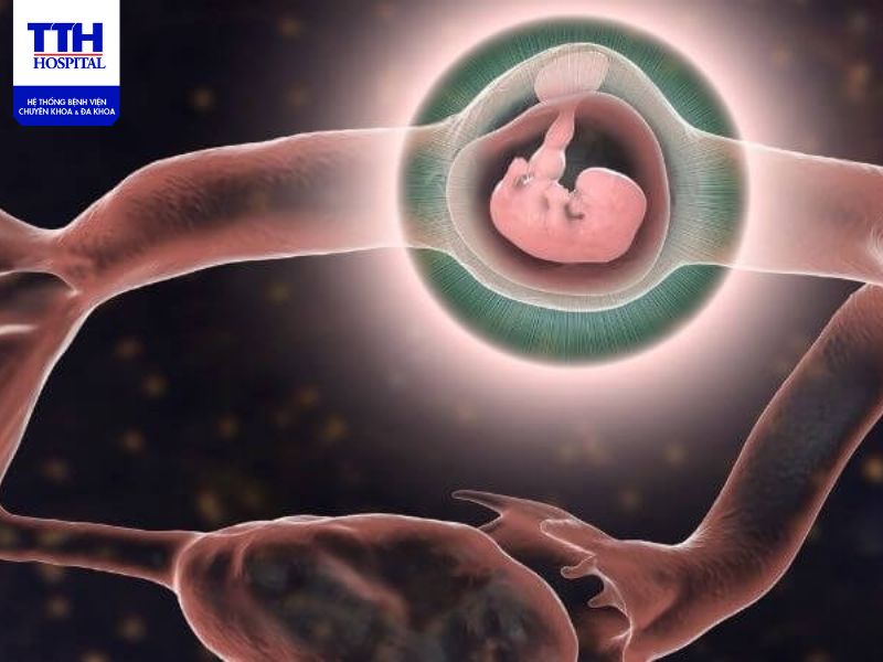 Nguyên nhân, triệu chứng và cách chữa trị và phòng ngừa mang thai ngoài tử cung