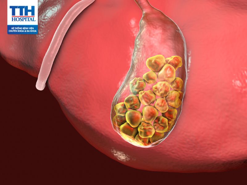 Sỏi mật là gì? Nguyên nhân, triệu chứng và phương pháp điều trị