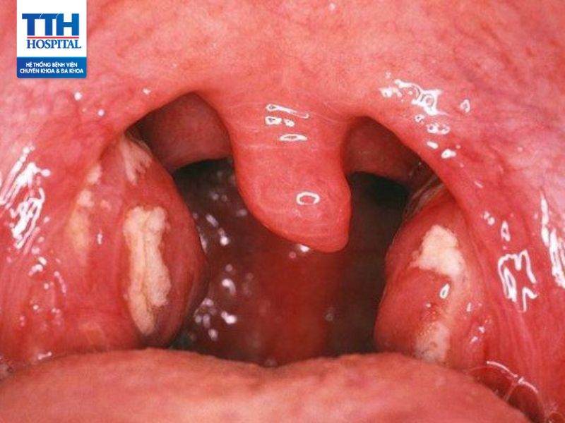 Amidan: Triệu chứng, nguyên nhân và phương pháp điều trị